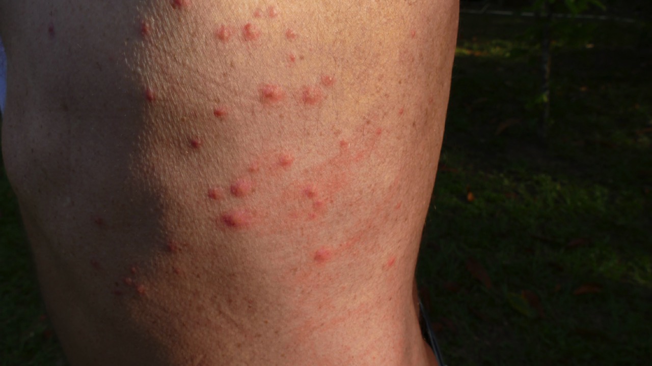 Bed bug bites